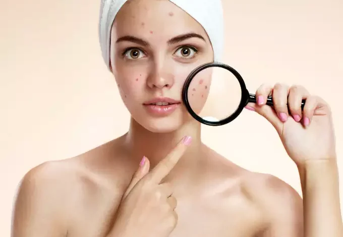 Get Rid of Those Pesky Dark Spots with Lemon Juice and a Few Household Ingredients