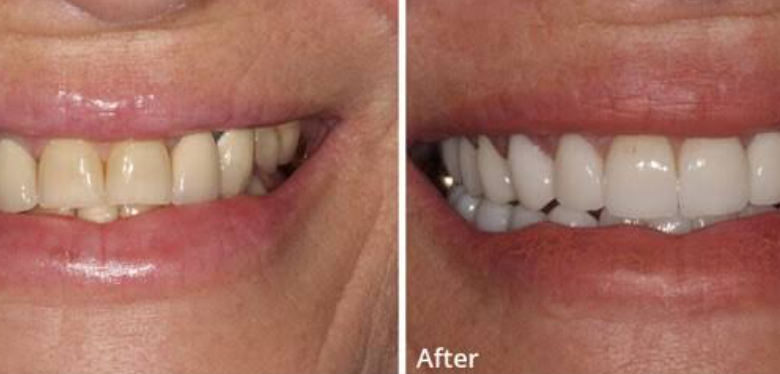 The Journey From Tooth Loss To Lasting Smile Restoration