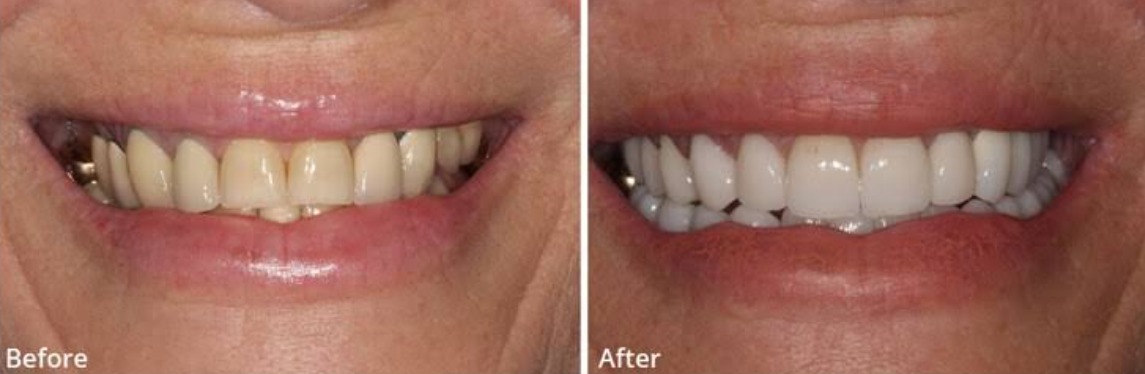 The Journey From Tooth Loss To Lasting Smile Restoration